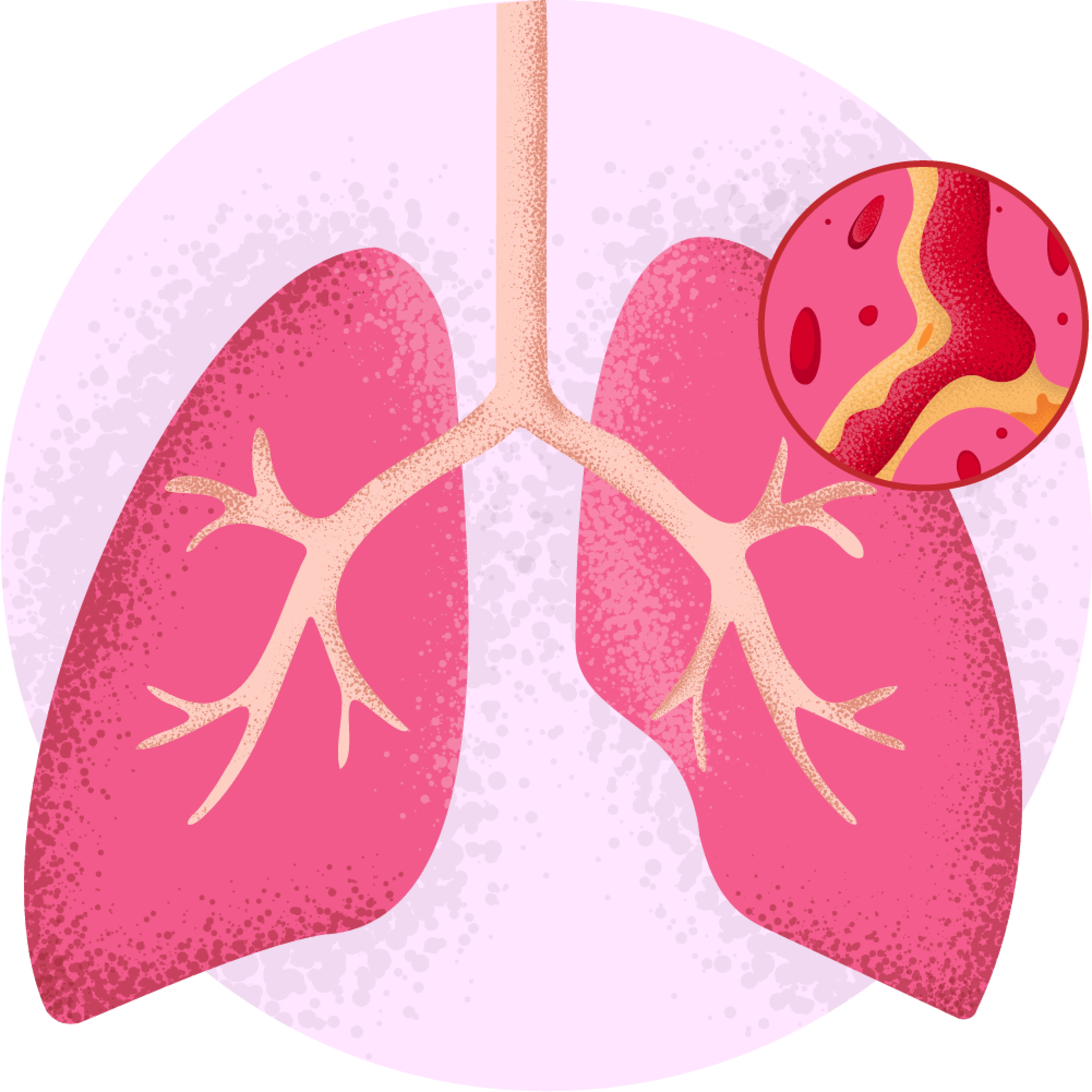 Bronchitis